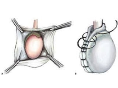 hyrocele-surgery-life-bloom-healthcare